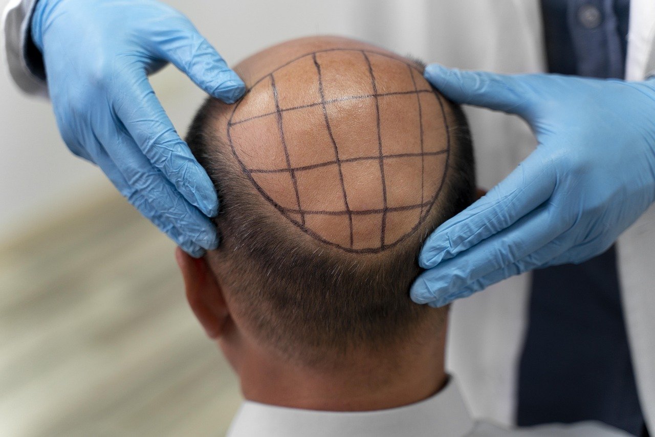Hair Transplantation